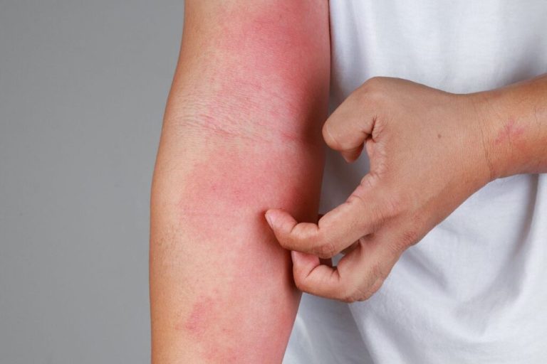 La dermatitis atópica impacta la calidad de vida de muchos chilenos