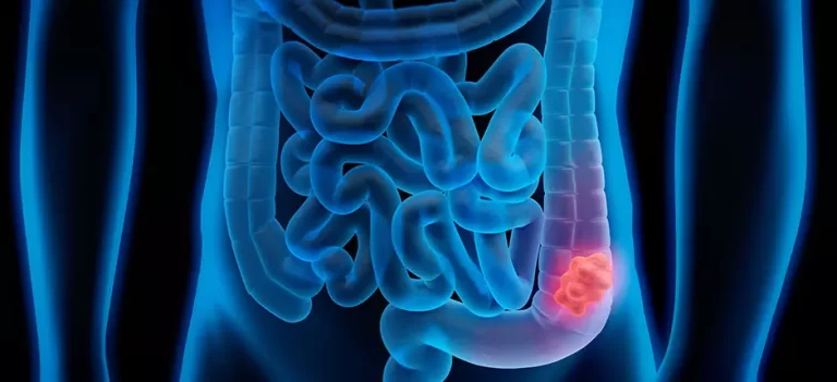 Cáncer colorrectal: Chile registra el segundo mayor incremento global en jóvenes