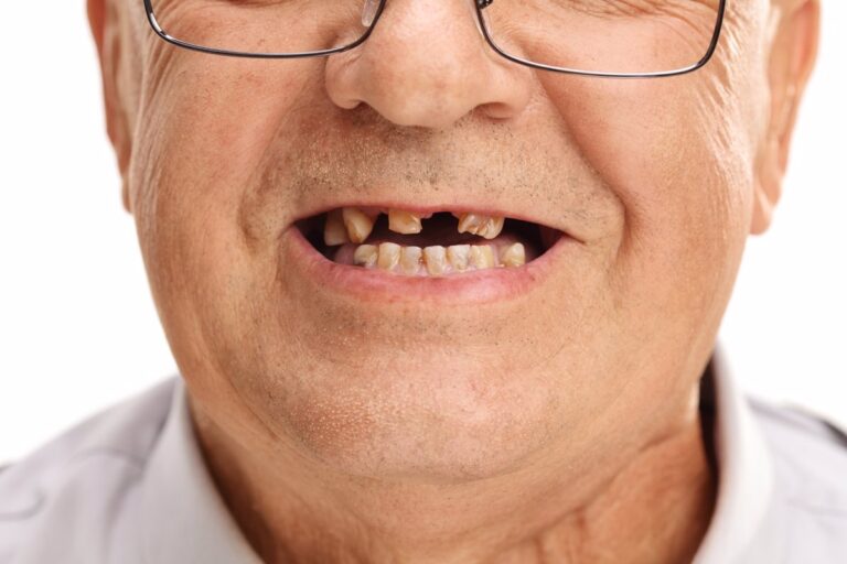 Solo el 1% de los chilenos llegará a la vejez con dentadura completa