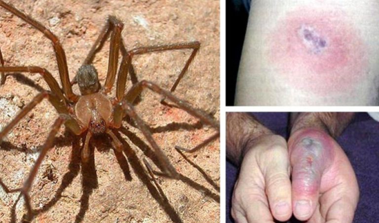 Araña de rincón: qué hacer ante su peligrosa mordida en verano